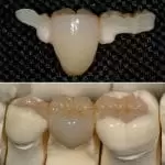 Composite_dental_bridge