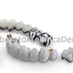 Punte Ceramica pe Titan