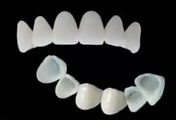 Punte | Coroana Dentara Provizorie