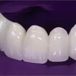 punte_dentara_zirconiu