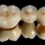 coroana zirconiu