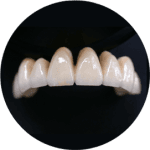 punte_totala_metalo_ceramica