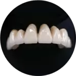 punte_totala_metalo_ceramica